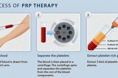 PRP Tedavisi ve PRP Kitlerin Etkinlik Bazında Değerlendirilmesi