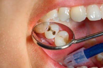 Kök Kanal Tedavisi (Endodonti) Nedir?